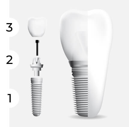 The three parts of a dental implant.