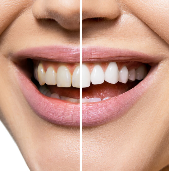 Before and after side by side of teeth whitening.